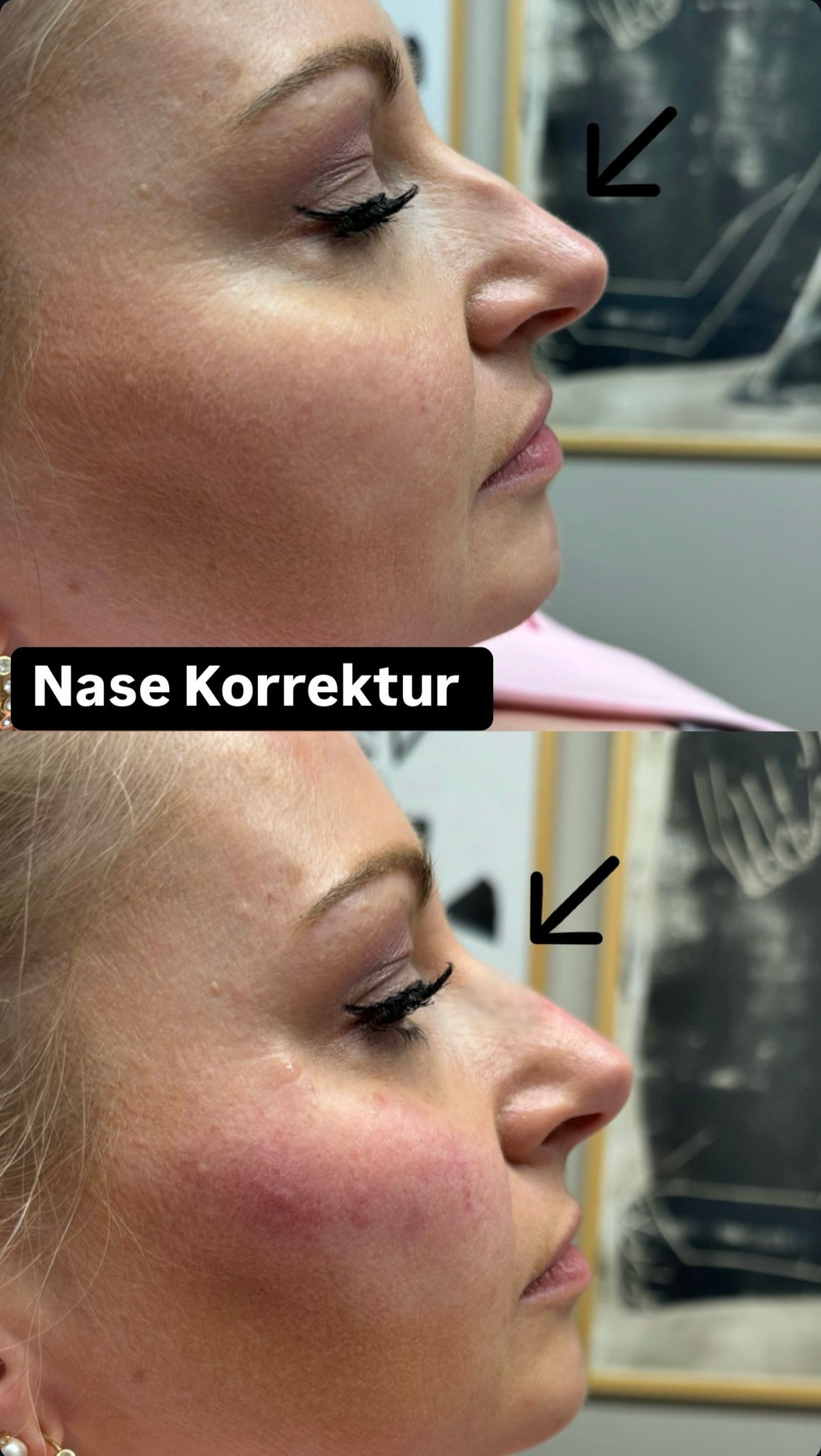 Nasenkorrektur 2