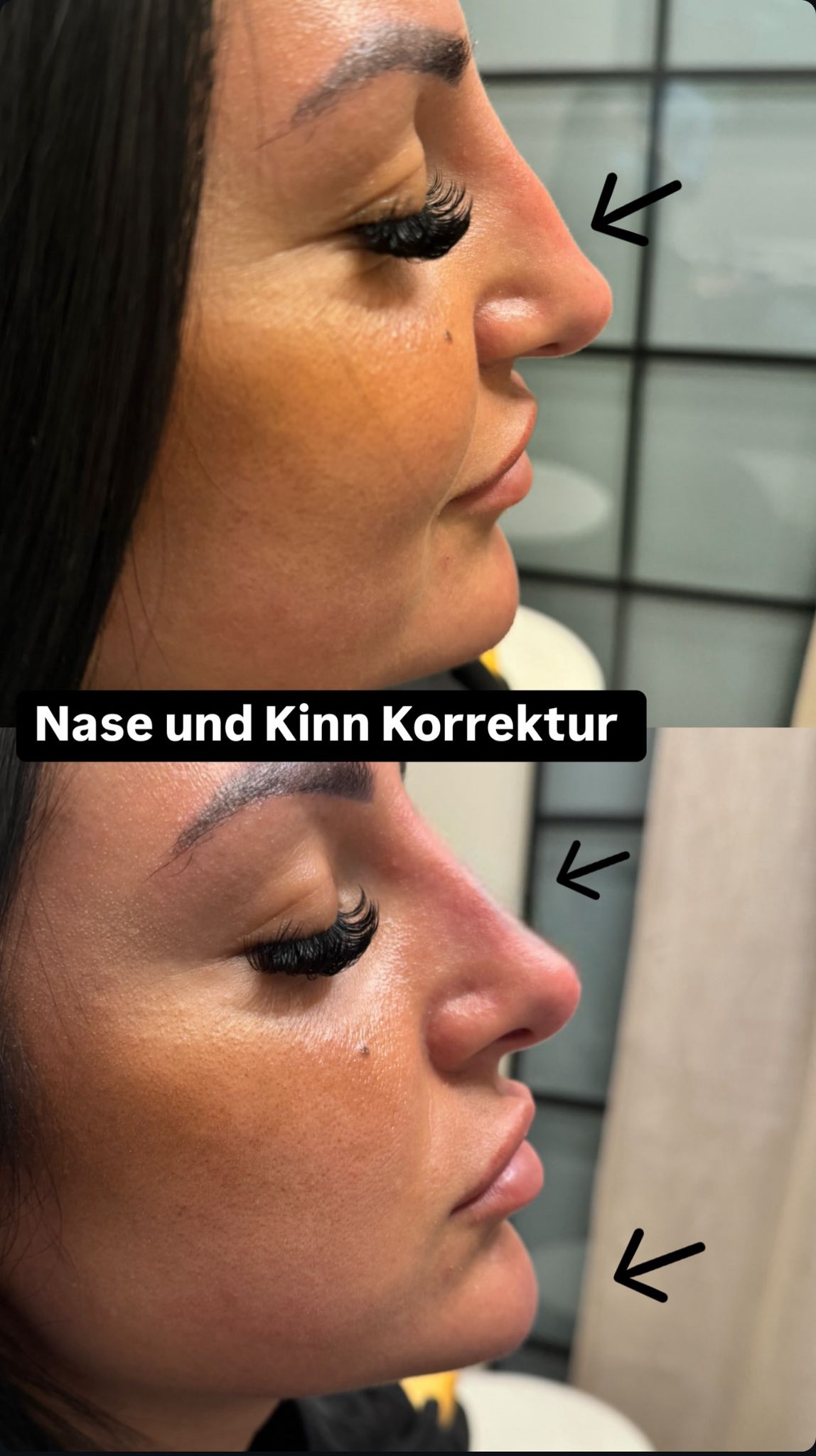 Nasenkorrektur 3